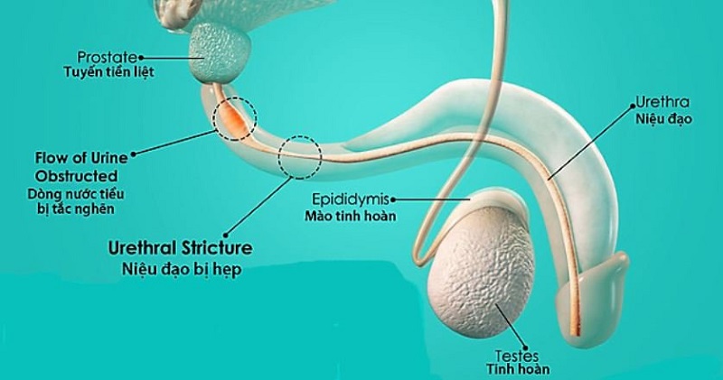 Triệu chứng hẹp niệu đạo ở nam giới